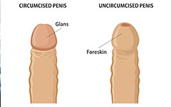 Circumcision Hatfield